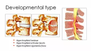 Spinal degenerative diseases Imaging   Prof  Dr  Mamdouh Mahfouz 720p