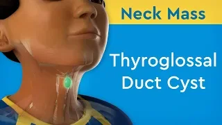 Neck Mass: Thyroglossal Duct Cyst