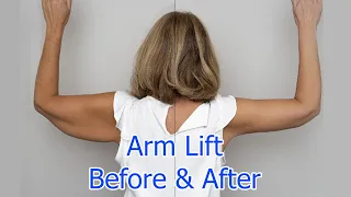 Arm Lift 14 Weeks Post Op FAQs | Brachioplasty Surgery Journey Part 3