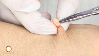 Clean Ganglion Sebaceous cysts removal surgery HD 腱鞘囊肿切除微手術 高清