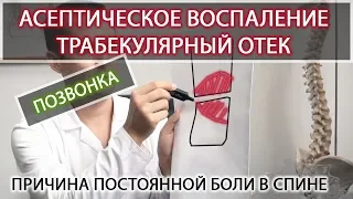 Ассептическое воспаление позвонка (трабекулярный отек). Вертебролог Игнатьев Радион Геннадиевич.