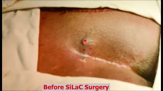 SiLaC Surgery Video