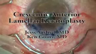 Crescentic lamellar keratoplasty for Terrien marginal degeneration
