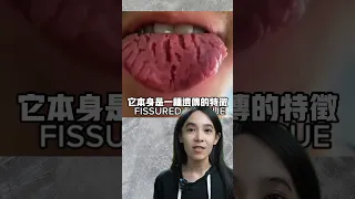 裂紋舌是火氣大嗎？