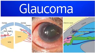 Glaucoma 2 | Diagnosis, Visual Field Defects