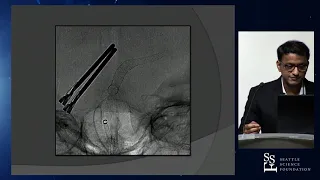 Aneurysms: Flow Diversion with Stents - Vivek R. Deshmukh, MD, FACS