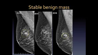 Mammography interpretation