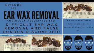 DIFFICULT EAR WAX REMOVAL & FALSE FUNDUS DISCOVERED   EP 362