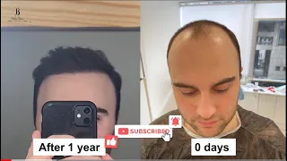 Detailed Video of Ruslan's Hair Transplant Journey