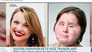 Face Transplant