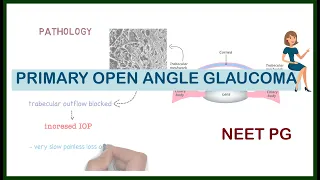 Primary Open Angle Glaucoma | ophthalmology | NEET PG |NEXT PG | FMGE