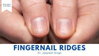 Do You Have Vertical Ridges On Your Fingernails? Here's What They Mean!