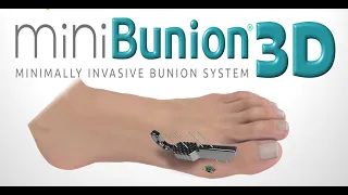 miniBunion 3D™ - MIS Bunion System with Viking™ Instrumentation