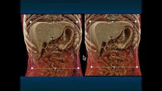 CT of the Stomach: Acute Processes - Part 2