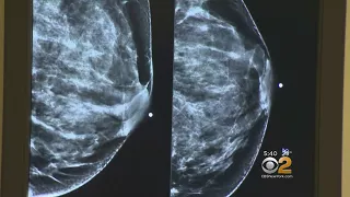 New Technology Helps Detect Cancer In Women With Dense Breast Tissue