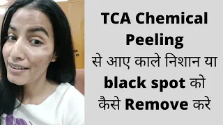 TCA Chemical Peeling से आए काले निशान या black spot को कैसे Remove करे|| Remove Black Spot