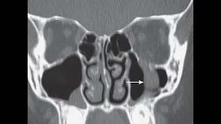 Blow out fracture of the Orbit