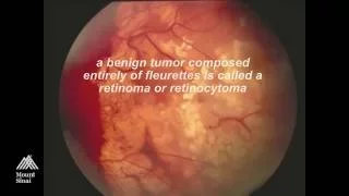 Retinoblastoma  by Ralph Eagle, MD