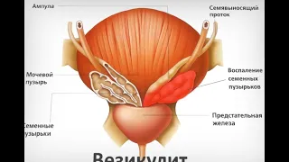 Везикулит