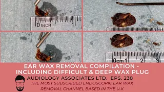 EAR WAX REMOVAL COMPILATION - INC DIFFICULT DEEP WAX PLUG - EP 238