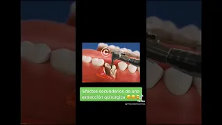 #short Consecuencias colaterales de una extracción dental quirúrgica complicada