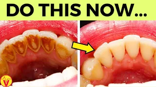 Natural Solution for Plaque, Cavities, and Gingivitis | #1 Top Remedy | VisitJoy
