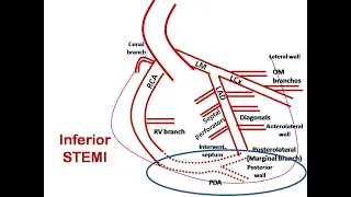 ECG course: Culprit in Inferior STEMI, Dr. Sherif Altoukhy