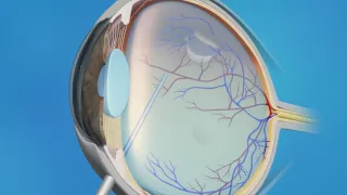 Detached Retina: Vitrectomy