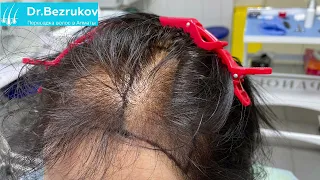 Пересадка волос в Алматы. Клиника Dr.Bezrukov.