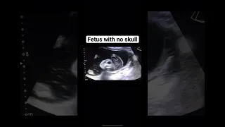 #acrania #anencephaly #fetus #ultrasound #fetalanomaly