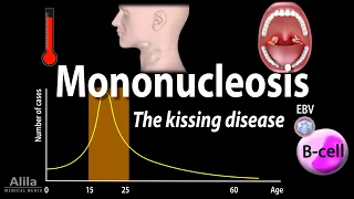 Infectious Mononucleosis (Mono) - the Kissing Disease, Animation