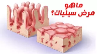 اعراض ومضاعفات مرض السيلياك وطرق علاجه