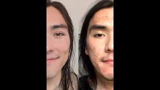 Accutane Transformation Timelapse #shorts