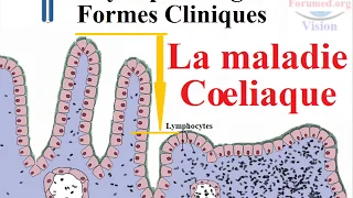 Maladie coeliaque physiopathologie et les Causes des Symptomes