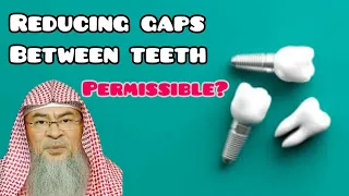 Is closing gaps between teeth permissible? - Assim al hakeem