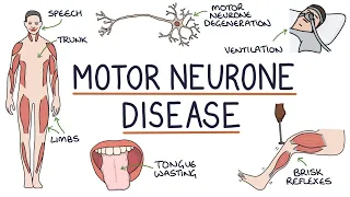 Understanding Motor Neurone Disease (Amyotrophic Lateral Sclerosis)