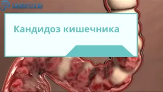 Кандидоз кишечника: виды, симптомы, диагностика и лечение болезни