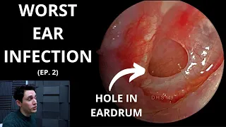 The Worst Ear Infection (Episode 2)