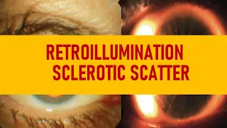 Slit lamp exam  | Retro illumination, Transillumination & Sclerotic scatter