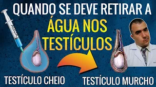 Quando se deve realizar a cirurgia de HiDROCELE (Água nos Testículos)?