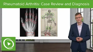 Rheumatoid Arthritis: Case Review, Diagnosis and Practice Questions
