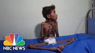 The Face Of Suffering: Famine, Cholera Wreak Havoc In War-Torn Yemen | NBC News