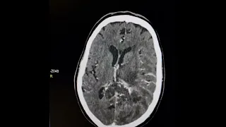 Butterfly glioblastoma multiforme of corpus callosum