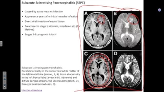 CNS infections 2 MW 113016