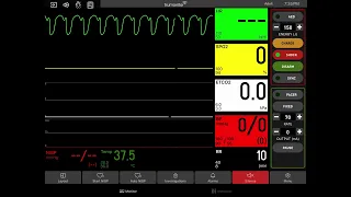 Pulseless Ventricular Tachycardia with Defibrillation