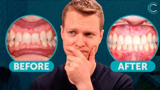 TEETH WERE DESTROYING EACH OTHER! Impossible Transformation Solved with Invisalign Ep2