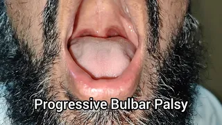 Tongue Fasciculations and Thenar Atrophy in Progressive Bulbar Palsy || Motor Neuron Disease
