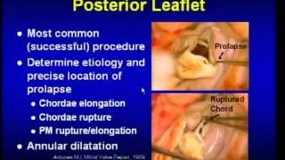 Cardiac Surgery: Mitral Valve Repair