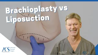 Brachioplasty (Arm Lift Surgery) Vs. Liposuction Explained By Plastic Surgeon, Dr. Tom McFadden