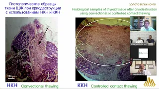 Разработка методики криодеструкции патологических тканей щитовидной железы (Божок Г.А.)